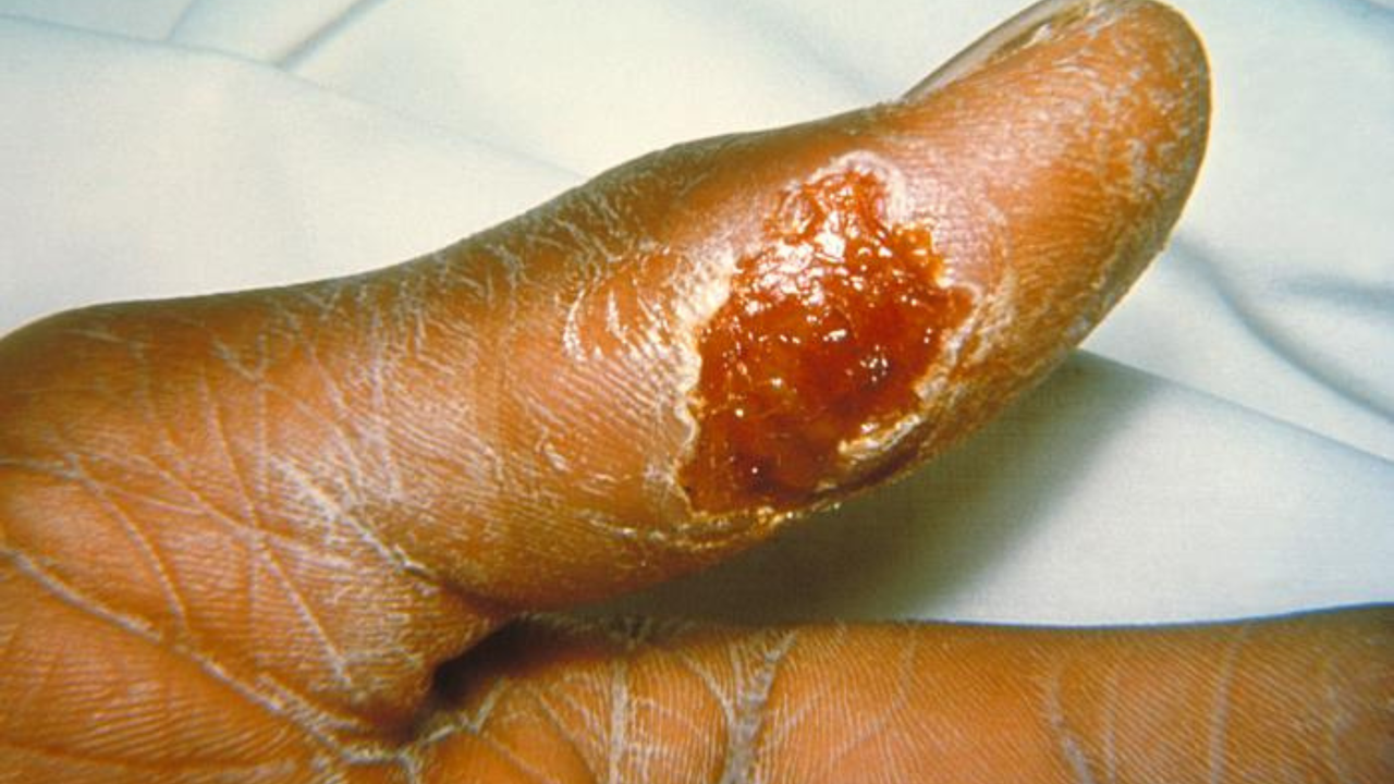 A close-up image of an ulcer on a person's thumb.