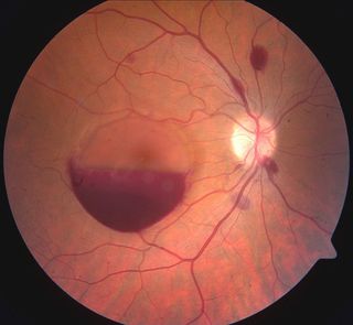 valsalva retinopathy