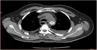 This CT of the man's thorax shows free air within the chest cavity, which can indicate an injury to the area.