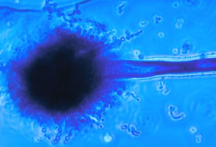 Can You Catch Meningitis Meningitis Transmission Live Science can-you-catch-meningitis-meningitis-transmission-live-science