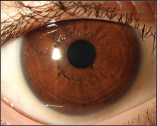 This is a photo of the boy's eye after his treatment for vitamin A deficiency. The eye has returned to a normal appearance. Reproduced with permission from JAMA Pediatrics. 2017. doi:10.1001/jamapediatrics.2017.2543