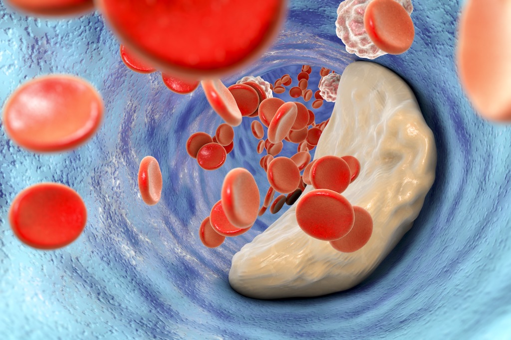 Cholesterol plaque in artery