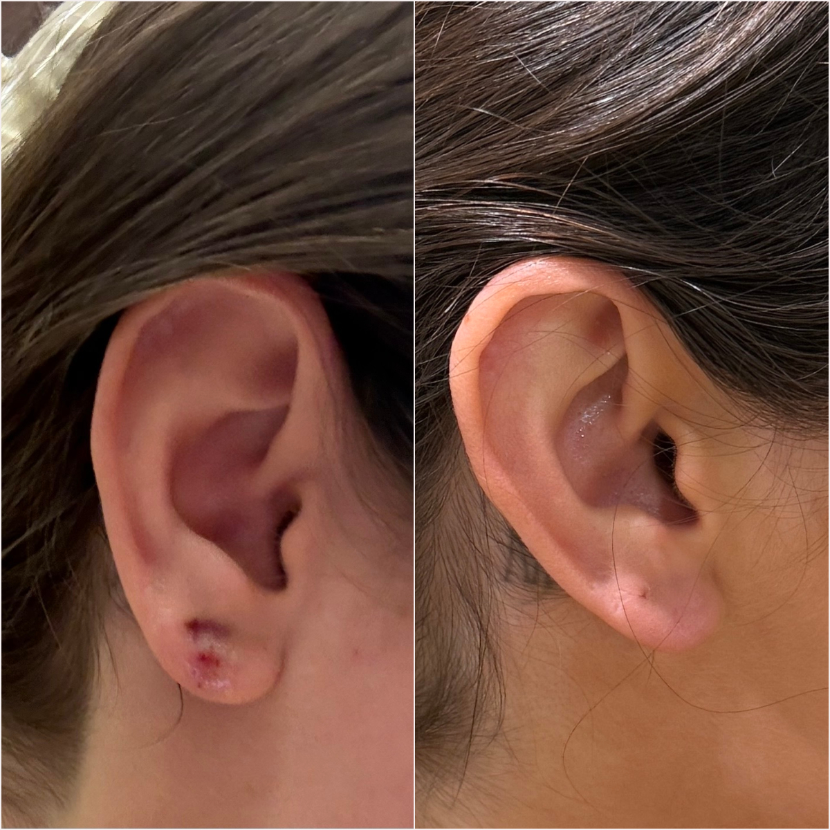 Side-by-side close-ups of the same earlobe after repair surgery. Left: bruising and liquid bandage after stitch removal. Right: fully healed earlobe nearly three months later.