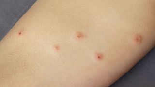 A cluster of bed bug bites