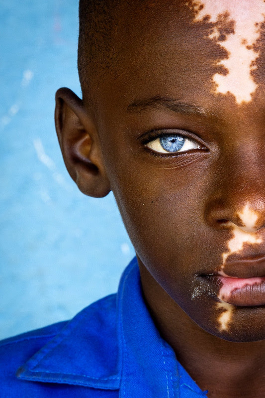 A close-up portrait of a child with dark skin, striking bright blue eyes, and patches of light skin caused by vitiligo, wearing a blue shirt against a blue background.