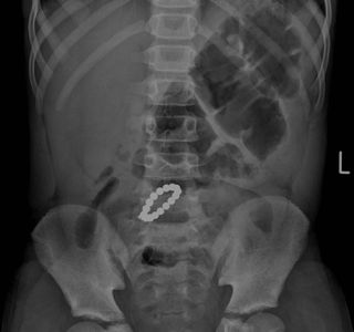 An X-ray of the boy's abdomen reveals 16 magnets he ingested separately.