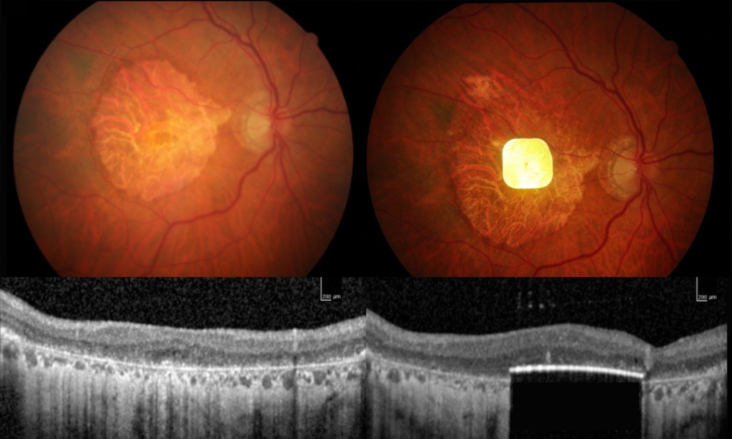 A scan of an eyeball with a chip visible inside