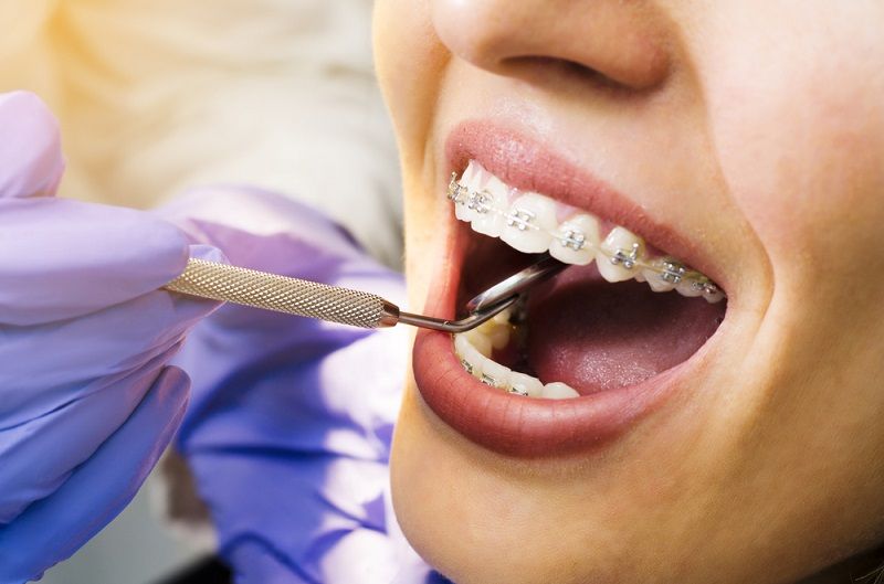 A woman with dental braces.