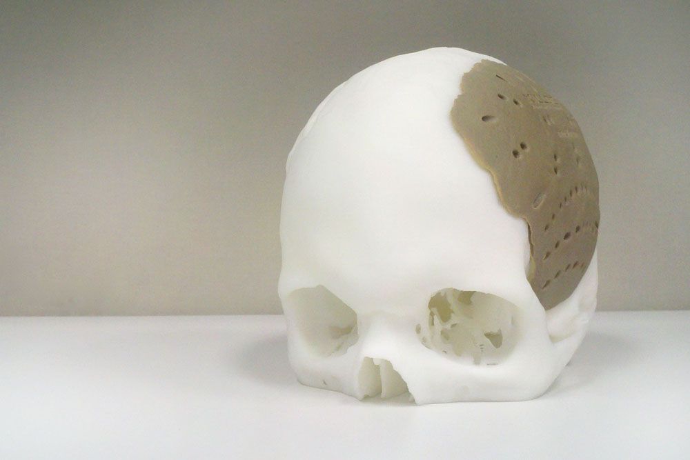 A 3D-printed skull implant.