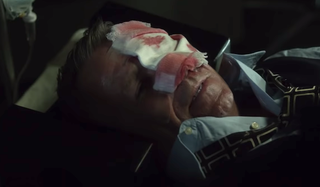 alfred injured in the face gotham