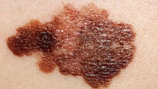 Close up of skin cancer.