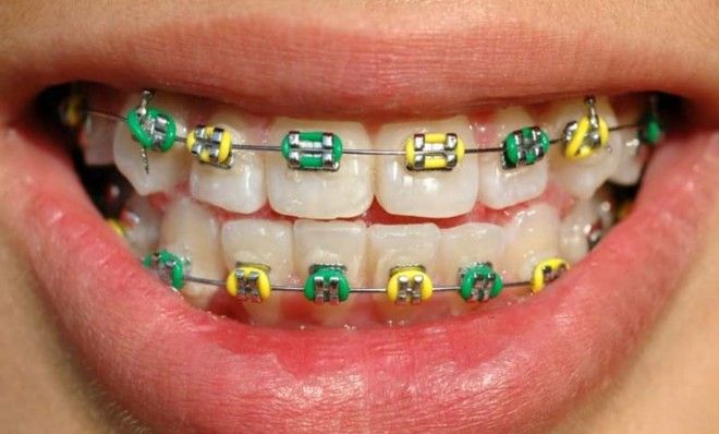 Braces