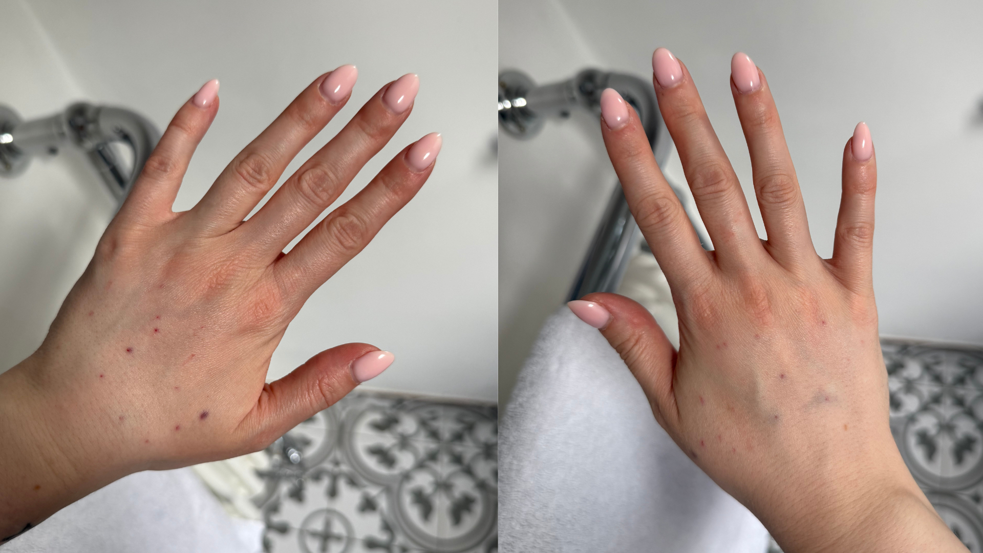Two adjacent images showing each of Lucy's hands after a polynucleotides session