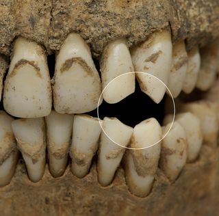 Close-Up of Dental Remains