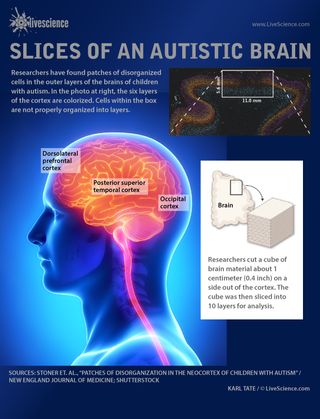 Patches of cells in the outer layer of the cortex are disorganized in the brains of autistic children.