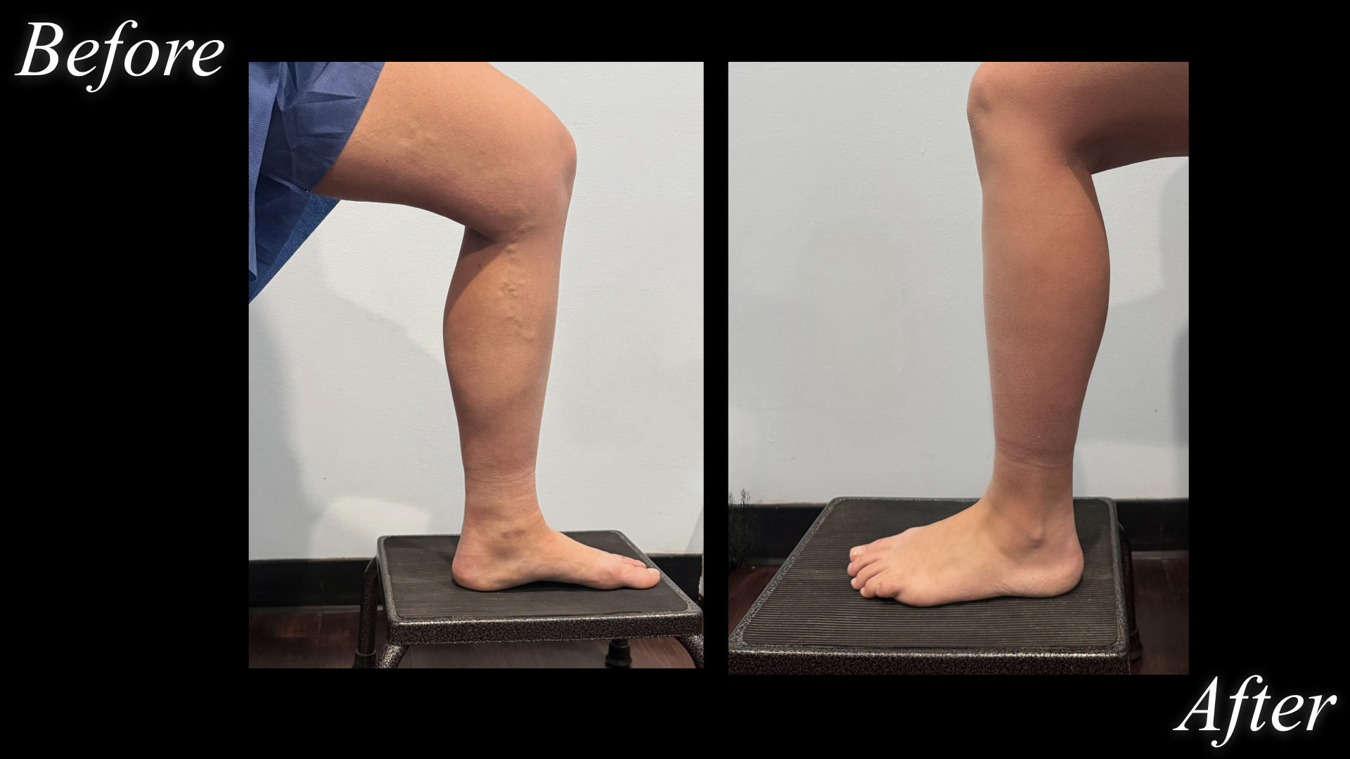 a before and after split image of a white woman's leg with varicose veins