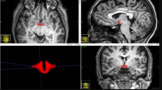 Brain MRI images showing the hypothalamus, in red. A new study finds that this brain region is smaller in women who use birth control pills, compared with women not taking the pill. 