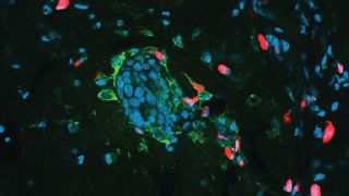 Some cancer cells in a mouse tumor have been engulfed by other cancer cells 