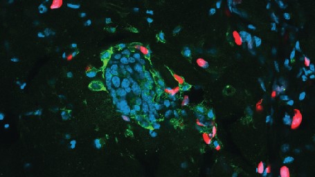Some cancer cells in a mouse tumor have been engulfed by other cancer cells 