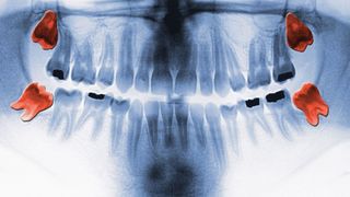 mouth x ray with wisdom teeth highlighted in red