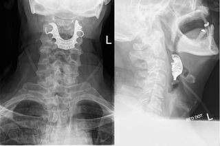 A U.K. man's dentures fell down his throat during surgery and were stuck there for more than a week. Above, an X-ray image of the man's neck showing the "missing" dentures.