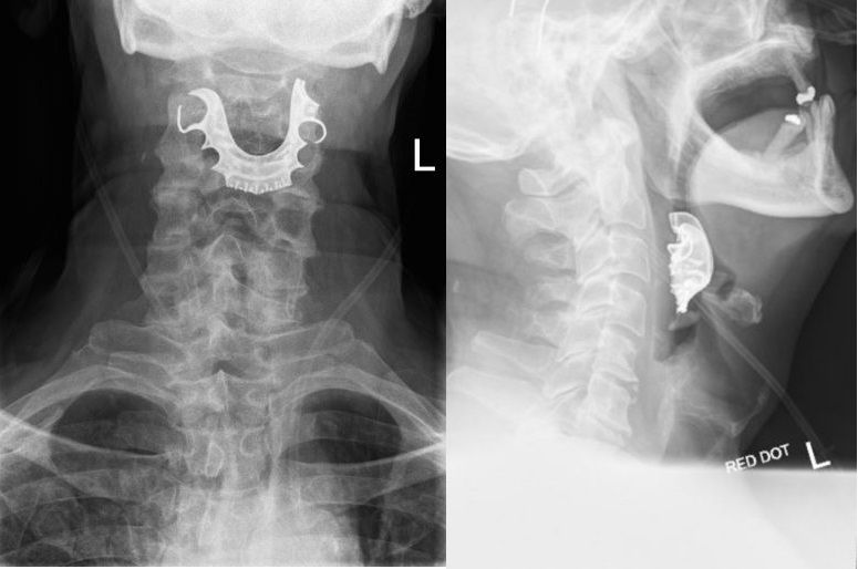 A U.K. man&#039;s dentures fell down his throat during surgery and were stuck there for more than a week. Above, an X-ray image of the man&#039;s neck showing the &quot;missing&quot; dentures.