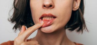 Close up shot of a woman's mouth showing gum disease