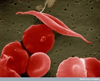 Normal red blood cells and a sickled blood cell.