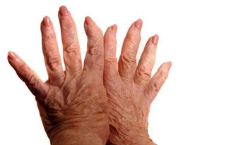 New insight into drugs that treat rheumatoid arthritis may help doctors personalize prescriptions for the condition.