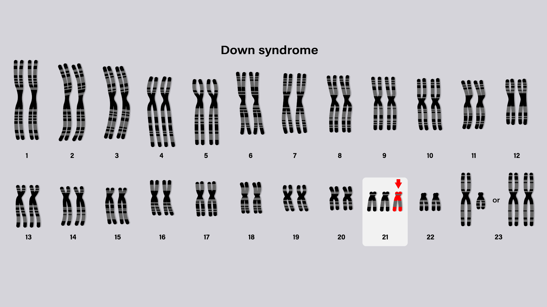 Trisomy in chromosome 21