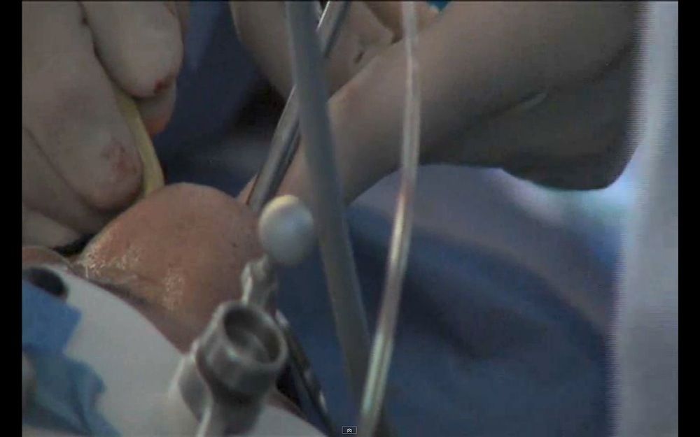 Brain surgery through nose