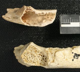 Neanderthal rib tumor
