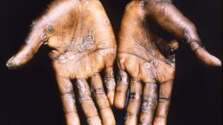 A close-up of hands covered in circular lesions