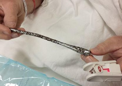 Man has turn signal removed from arm after 51 years