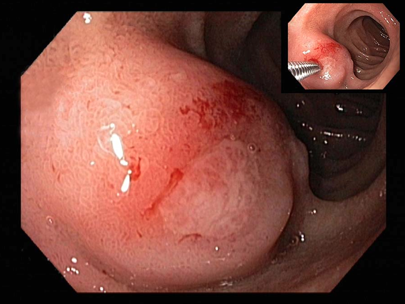 Lump in duodenum from bacterial infection