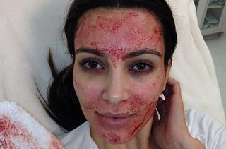 Kim Kardashian Vampire Facial