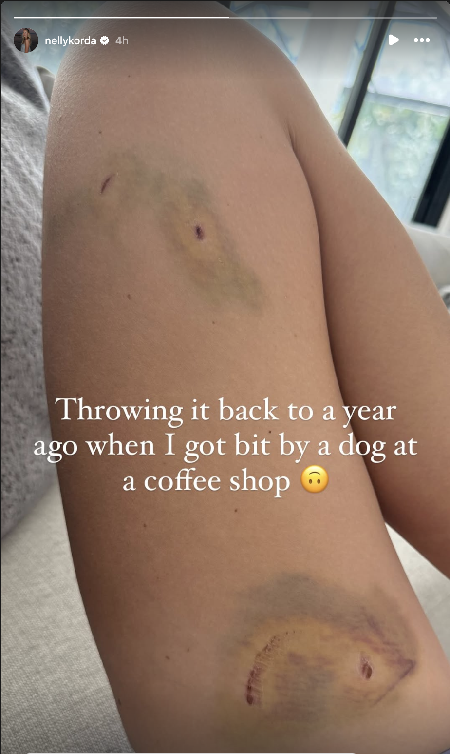 A screenshot of Nelly Korda's Instagram story where she showed off her dog bite