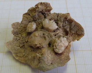 Archaeologists discovered this ovarian teratoma, or a tumor that had started sprouting teeth, in a burial outside the Church and Convent of Carmo in Lisbon.