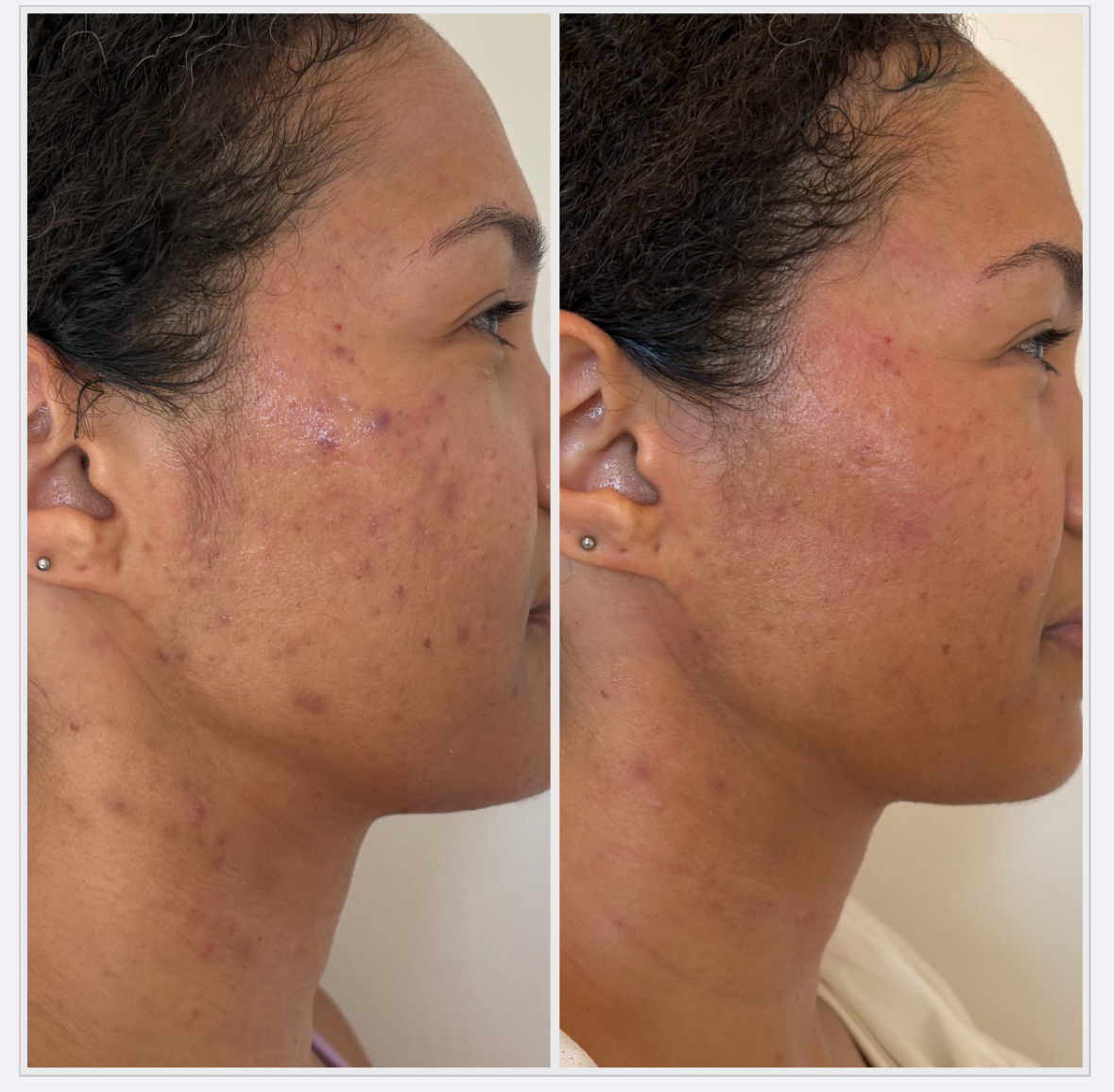 A beauty editor&#039;s results with DMK StemZyme therapy.
