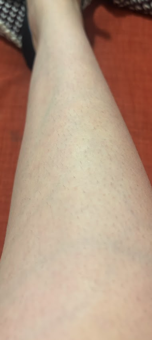 Julia Marzovilla tests the Mismon Hair Removal Device