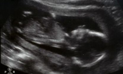 The couple's 16-week ultrasound photo of the baby they have nicknamed "Wiggles."