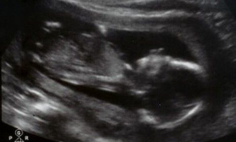 The couple&amp;#039;s 16-week ultrasound photo of the baby they have nicknamed &amp;quot;Wiggles.&amp;quot;