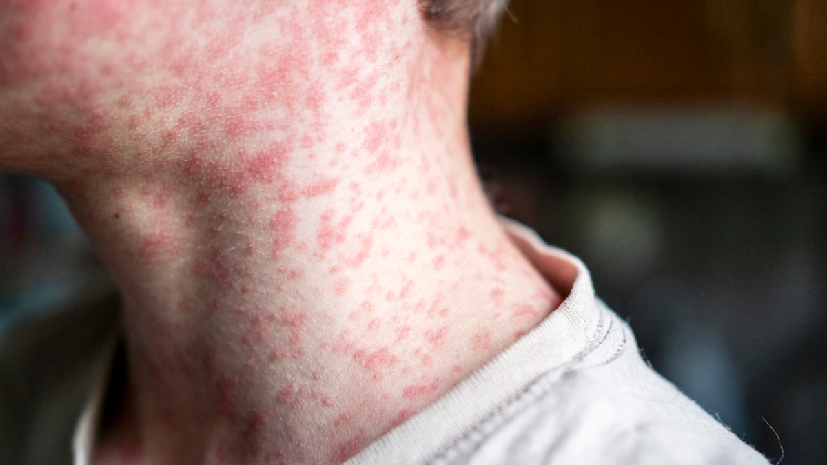 Measles' resurgence in the US is a grim sign of what's coming