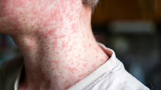 Human skin covered with measles rash.