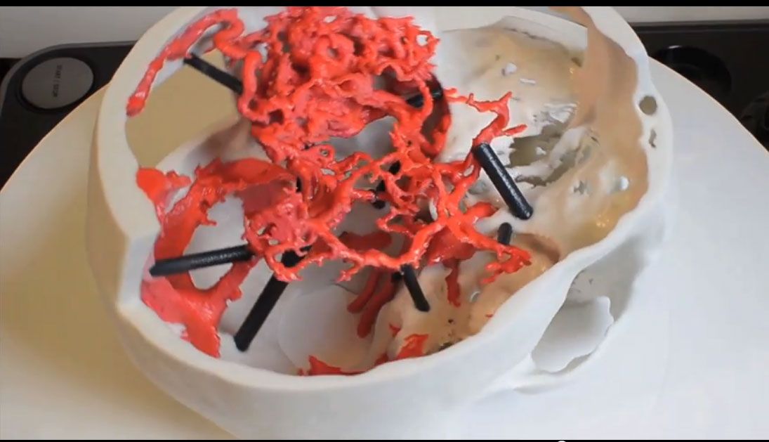 3D printed models, like the one of brain tissue above, can aid surgeons in medical procedures.