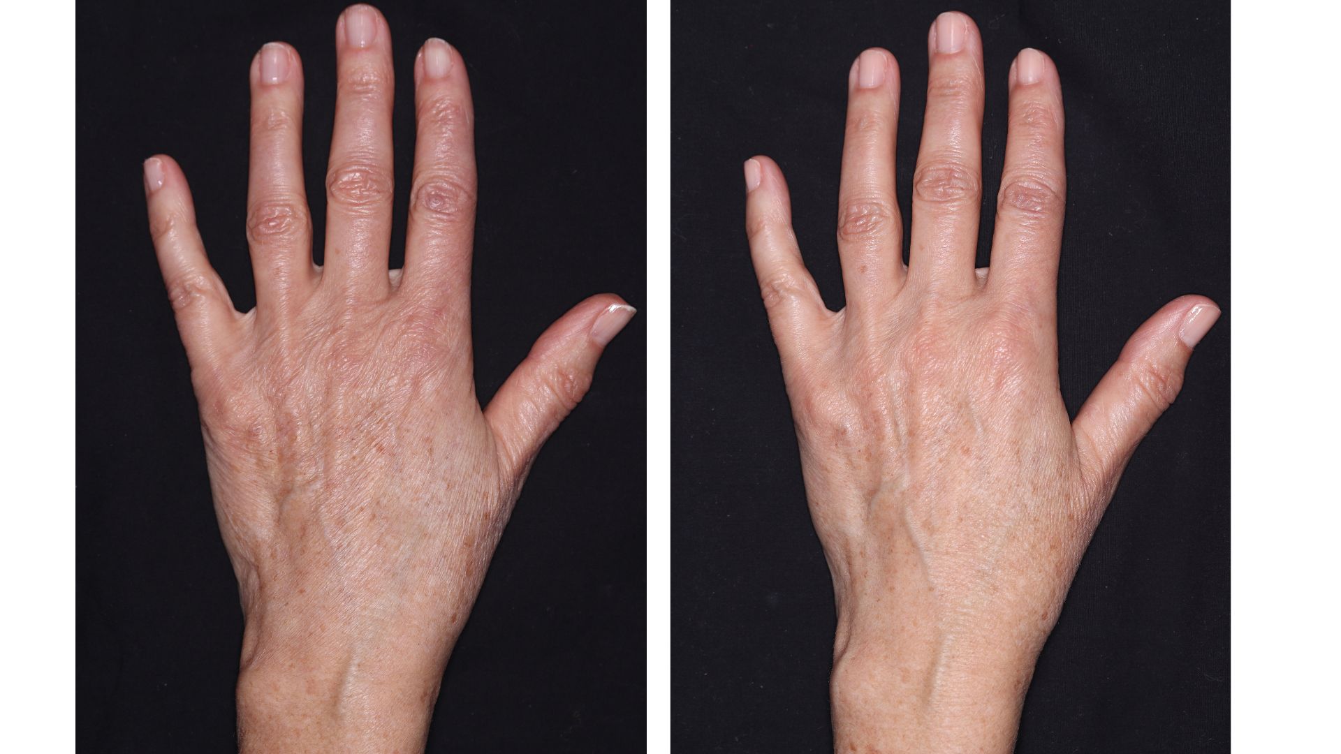 a hand pictured before and after trying Trinny London Overnight Hand Transformation for 12 weeks, in the after picture pigmentation is visibly reduyced and the skin texture improved
