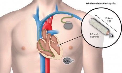 The wireless pacemaker as small as a grain of rice | The Week