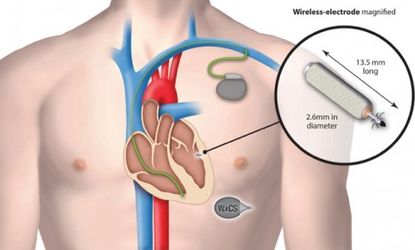 Illustration of the wireless pacemaker 