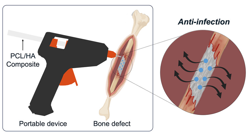 graphic of a glue gun that 3D prints bone material onto a fracture