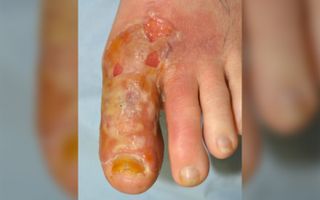 A 45-year-old woman got burns and blisters on her toe after trying to treat her athlete's foot with raw garlic.